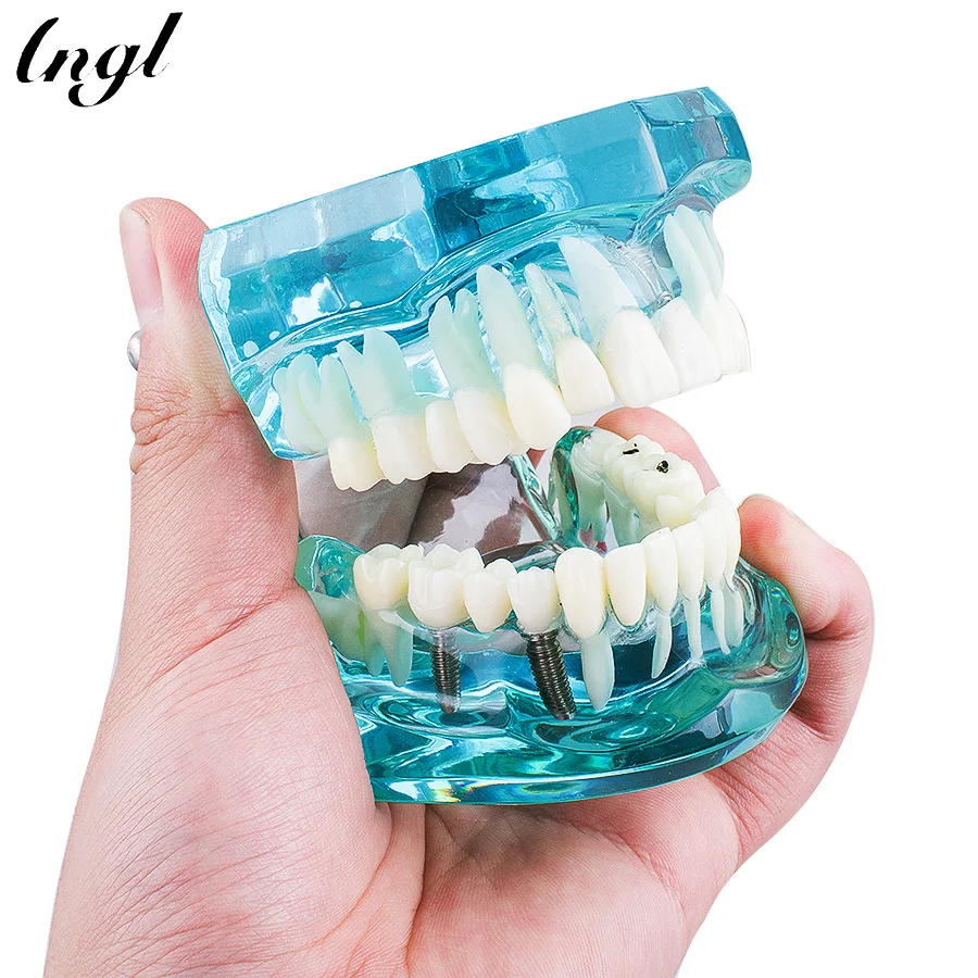 Goedkoop 1 stuk Volwassen Dental Resin Restauratie Model Tanden Studie Model Tandarts Gereedschap Tandheelkunde Laboratorium Transparant Model