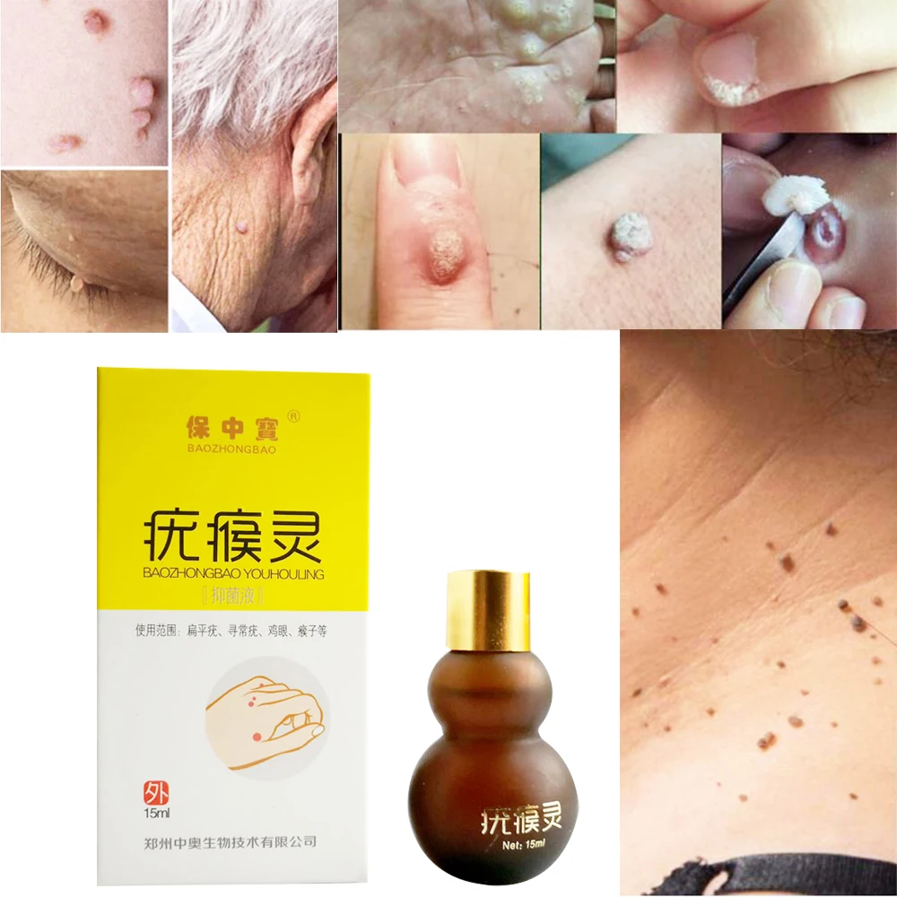 

15ml Skin Tag Remover Body Warts Treatment Foot Corn Removal Plantar Genital Warts Ointment Foot Care Medical Plaster D186