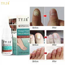 Удаление 99.9% бактерий травяной грибок лечение ногтей масло сыворотка Onychomycosis анти грибковая инфекция ногтей 10 мл ремонт ногтей