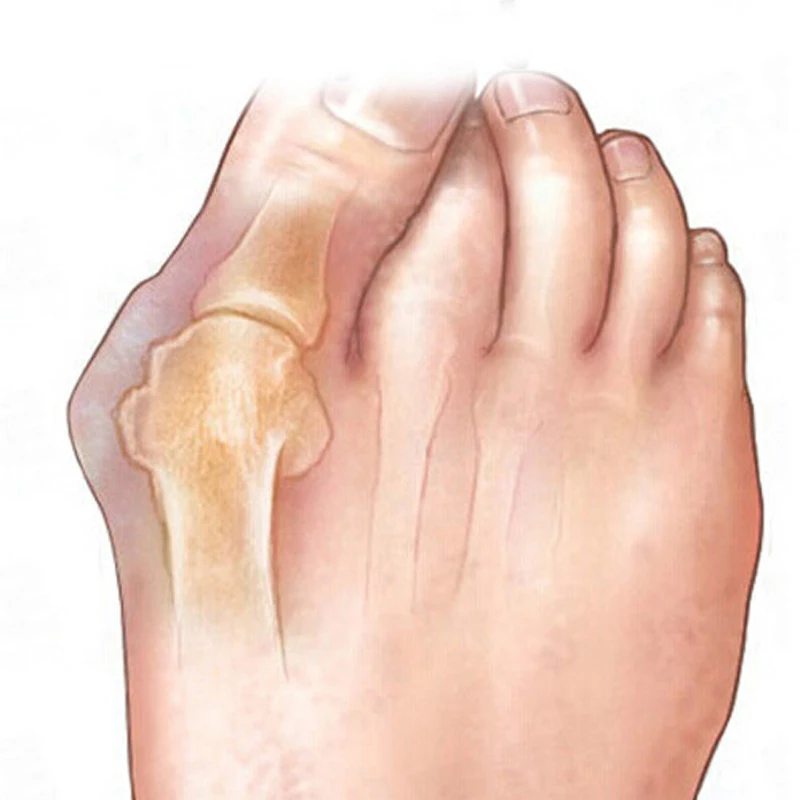 1 пара = 2 шт силиконовый гелевый корректор пальцев ног разделитель пальцев ног вальгусная деформация педикюра Инструменты для ухода за ногами корректор для пальцев ног