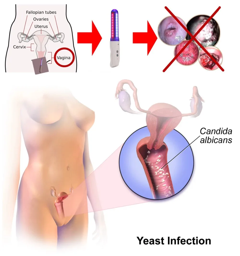 2019 вагинальная стимуляция светотерапия устройство для влагалища оздоравливающий продукт
