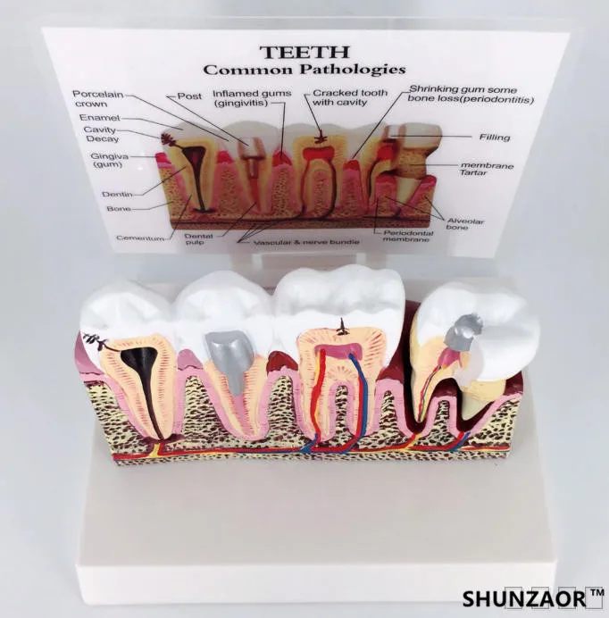 

teeth common pathologies teaching model ,Teeth Whitening Tooth Dentist for Medical Science Teaching