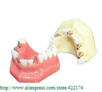 Модель имплантата зубной зуб зубы Стоматологическая анатомическая Стоматологическая модель