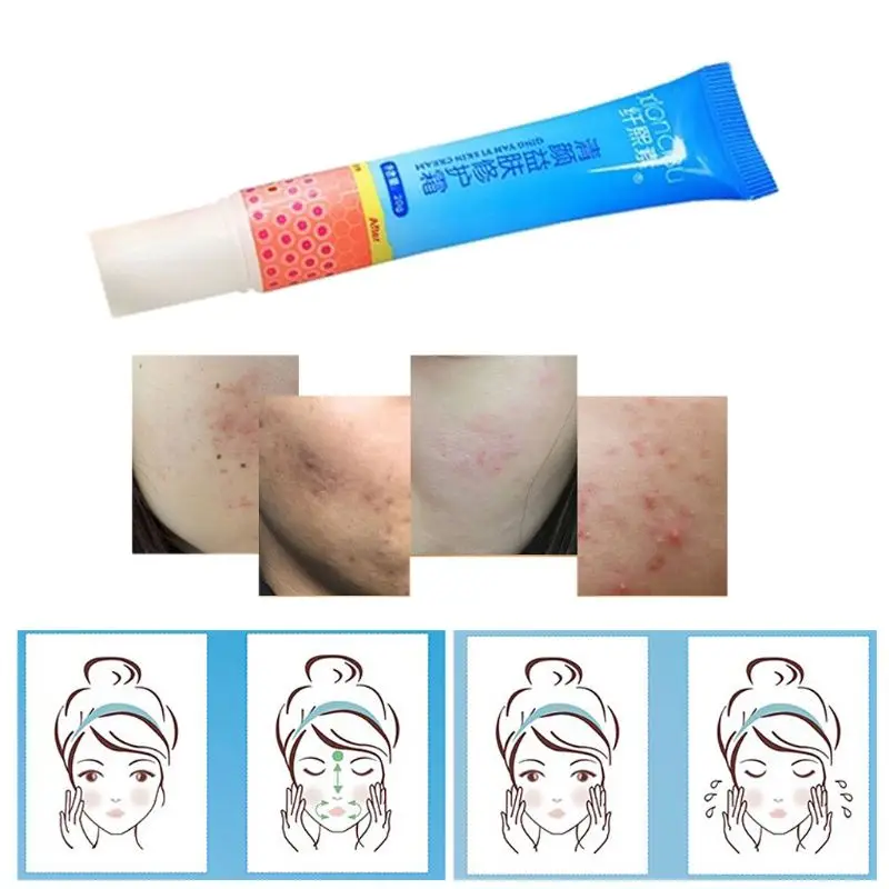 

Acne Treatment Scar Removal Anti Acne Cream Oil Control Shrink Pores Face Care Whitening Moisturizing