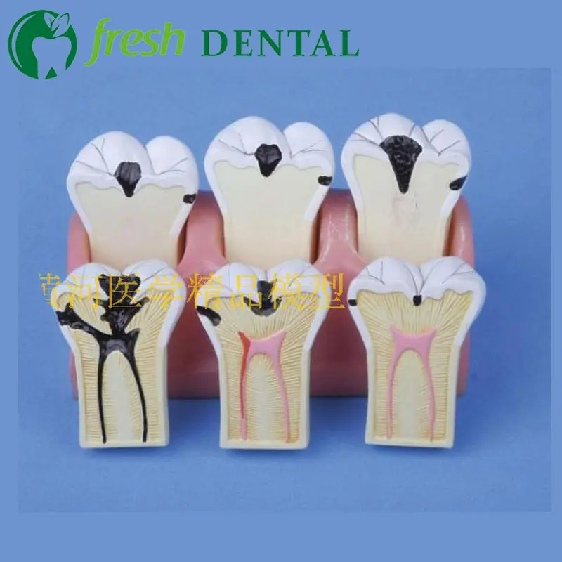 1 шт. кариеса разложения Модель Стоматологическая учение модель человеческого коренных зубов Модель SL718