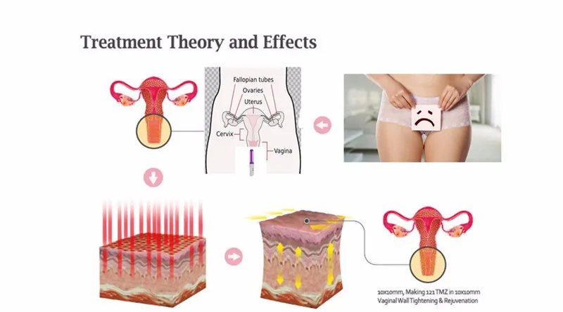 Низкий уровень лазерной продукт здоровья 650 нм инфракрасный гинекологические заболевания терапии для вагинальный затянуть терапии