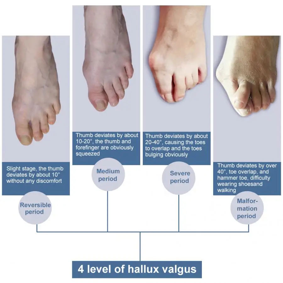 1 шт. бурьон устройства спецодежда медицинская Hallux корректор для косточки на ноге черный носок сепараторы ночь ортопедические подтяжки Уход за ногами