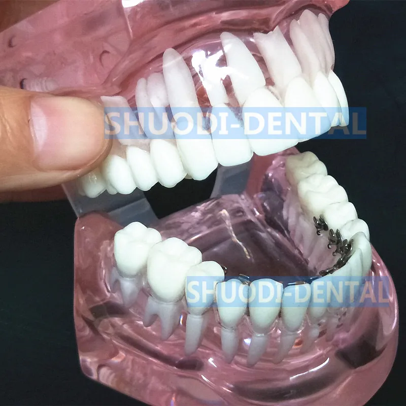 Стоматологическая Ортодонтическая модель с языковыми кронштейнами для стоматолога-Исследования связи пациента прозрачная модель зуба
