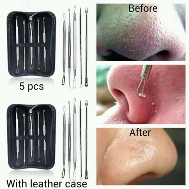 5 pcs Blackhead Whitehead Pimple Acne Blemish Remover Tool Set Kit