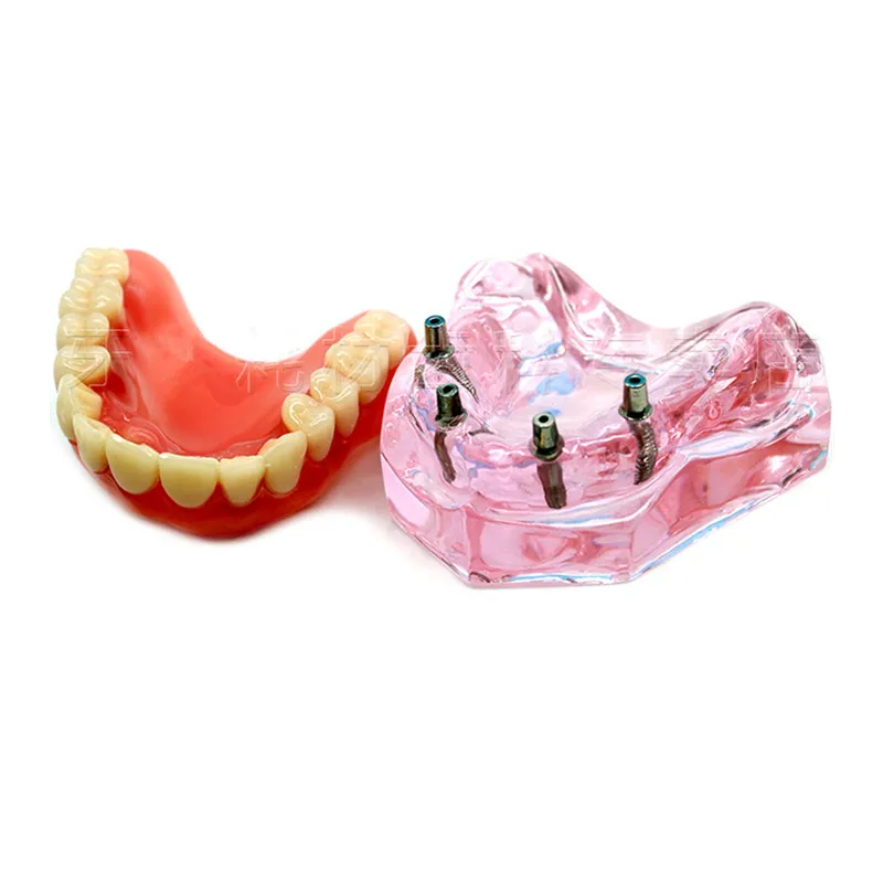 Стоматологический верхний протез Улучшенный 4 имплантаты демонстрационная модель 6001 02 модель зубов
