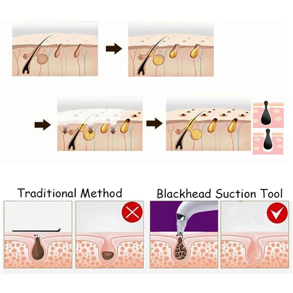 Электрический Нос очиститель пор глубокое удаление черных точек очищающее средство для лица вакуум угорь 2U81018