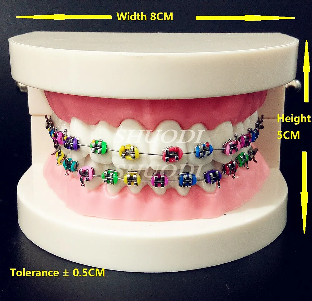 Dental Orthodontic Treatment Model With Ortho Metal Bracket Arch Wire