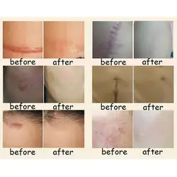 Новые горячие Nuobisong удаление лицевого рубца Cremas лица пятна лечение отбеливание крем для лица растяжки увлажняющий