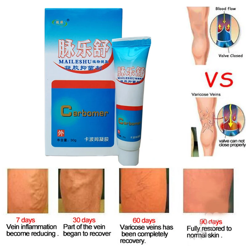 Varicose Veins Treatment Cream Old Bad Leg Vasculitis Cream Varicose