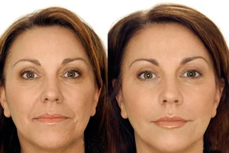 Anti-Aging