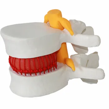 

quality Medical human lumbar disc herniation demonstration model lumbar spine model lumbar vertebra