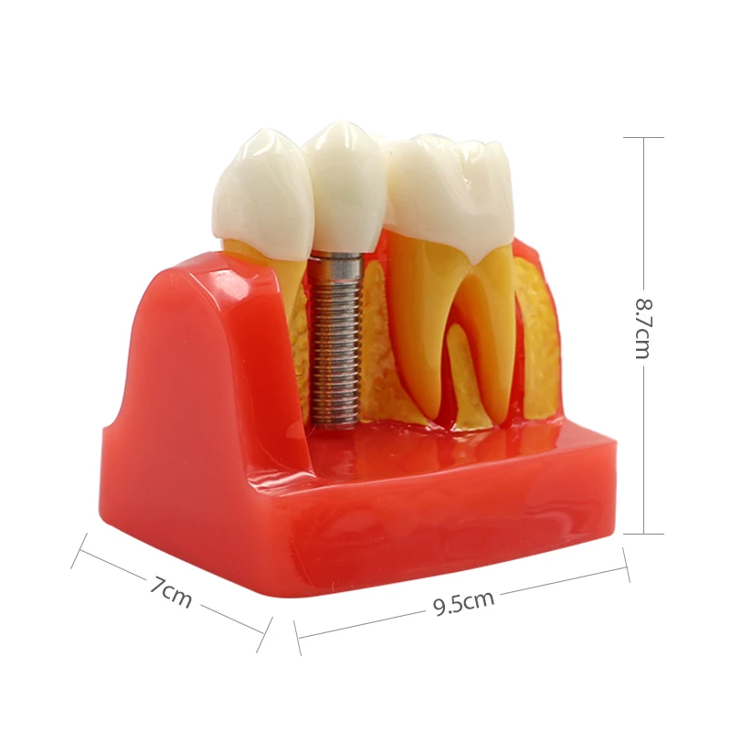 Зубные научить имплантата анализ Корона мост Съемная Модель Стоматологическая модель зубов обучения, изучения стоматолог модель