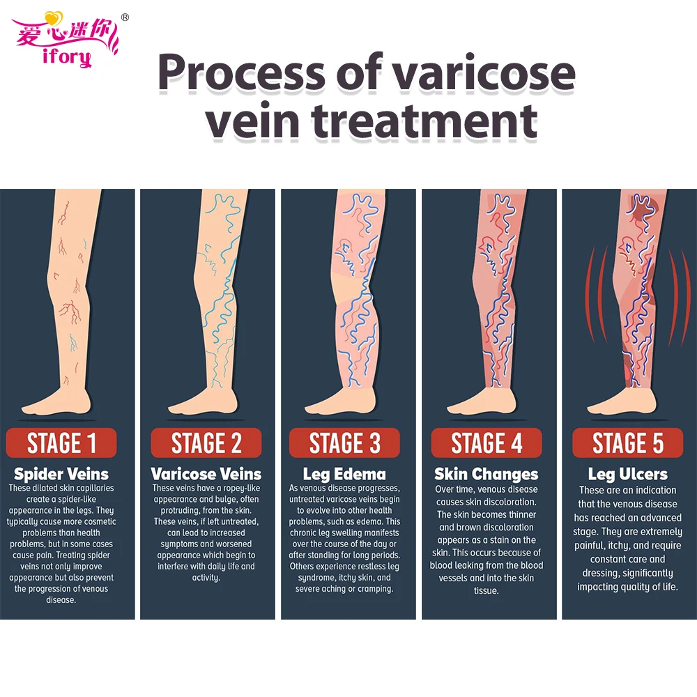 Ifory, 5 коробок, натуральный травяной крем для лечения варикозного расширения, сосудистых воспалений, массажный крем для лечения варикозного расширения вен, мазь, Прямая поставка