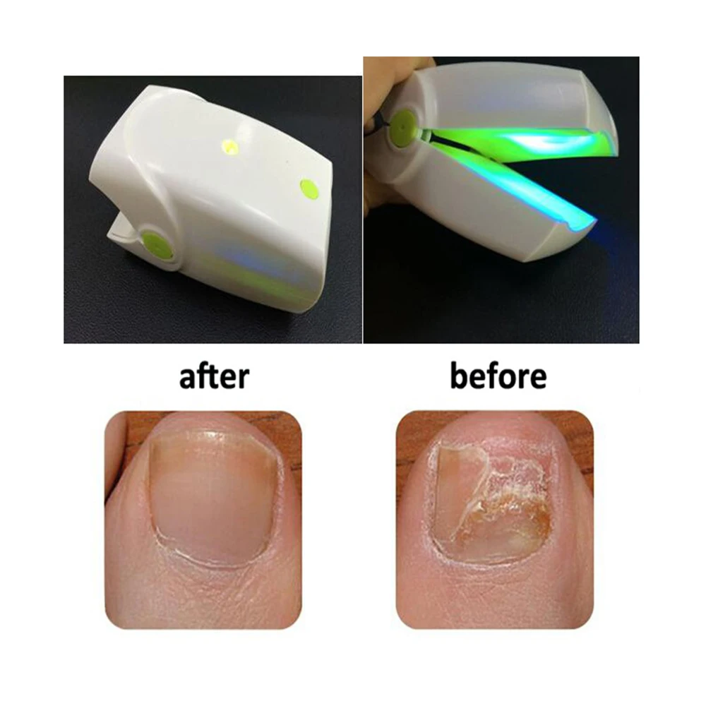 

Women finger beauty beauty Laser treatment of onychomycosis infections cold laser therapy machine