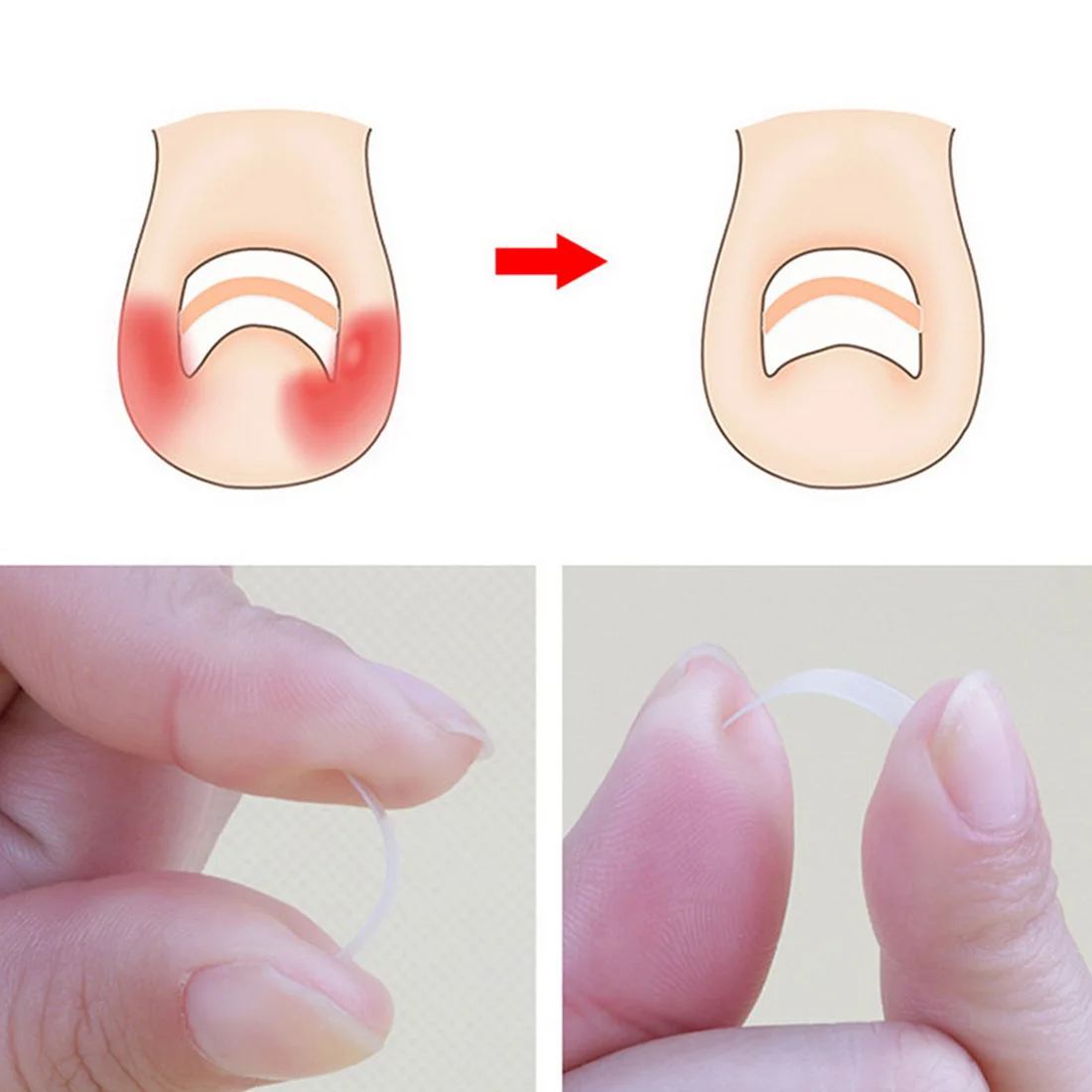New Ingrown Toe Nail Correction Sticker Patch Paronychia Corrector File Elastic Patch Corrector Foot Care Treatment Pedicure New Ingrown Toe Nail Correction Sticker Patch Paronychia Corrector File Elastic Patch Corrector Foot Care Treatment Pedicure