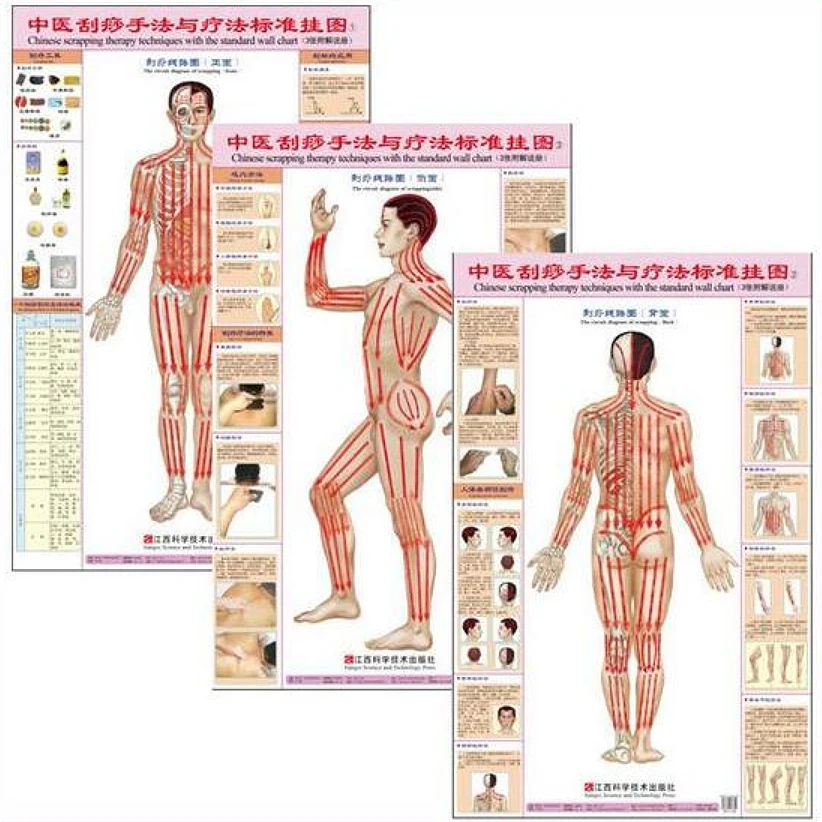 Китайский слом методы терапии с Стандартный настенные диаграммы набор из 3 шт. (передняя сторона задняя) гуа Ша настенные диаграммы