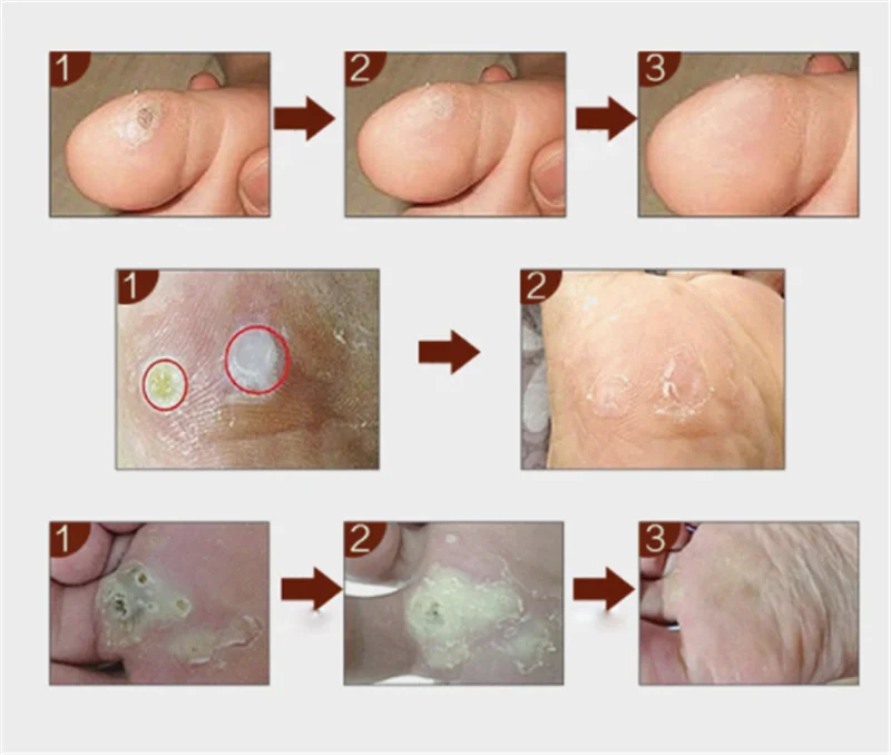 12 шт. медицинский пластырь для удаления мозолей для ног, бородавки, шип, пластырь для мозолей, средство для детоксикации ног