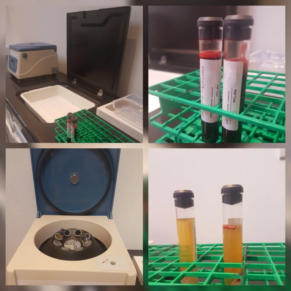 Популярная центрифуга PRP для 10 шт kit 8 мл 12 15 ACD гелевая трубка ухода за волосами и