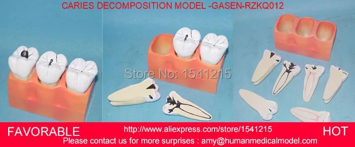Кариеса модель, стоматологические модели, Стоматологическая Литой Модель для Отдела стоматологии, медицинская Анатомия MODEL-GASEN-RZKQ012