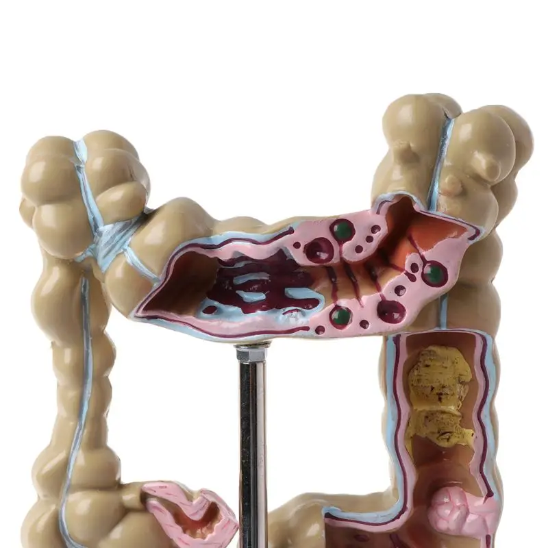 Человека, модель поражения патологическая анатомия Колон заболеваний кишки для медицинской учебной обучающий инструмент