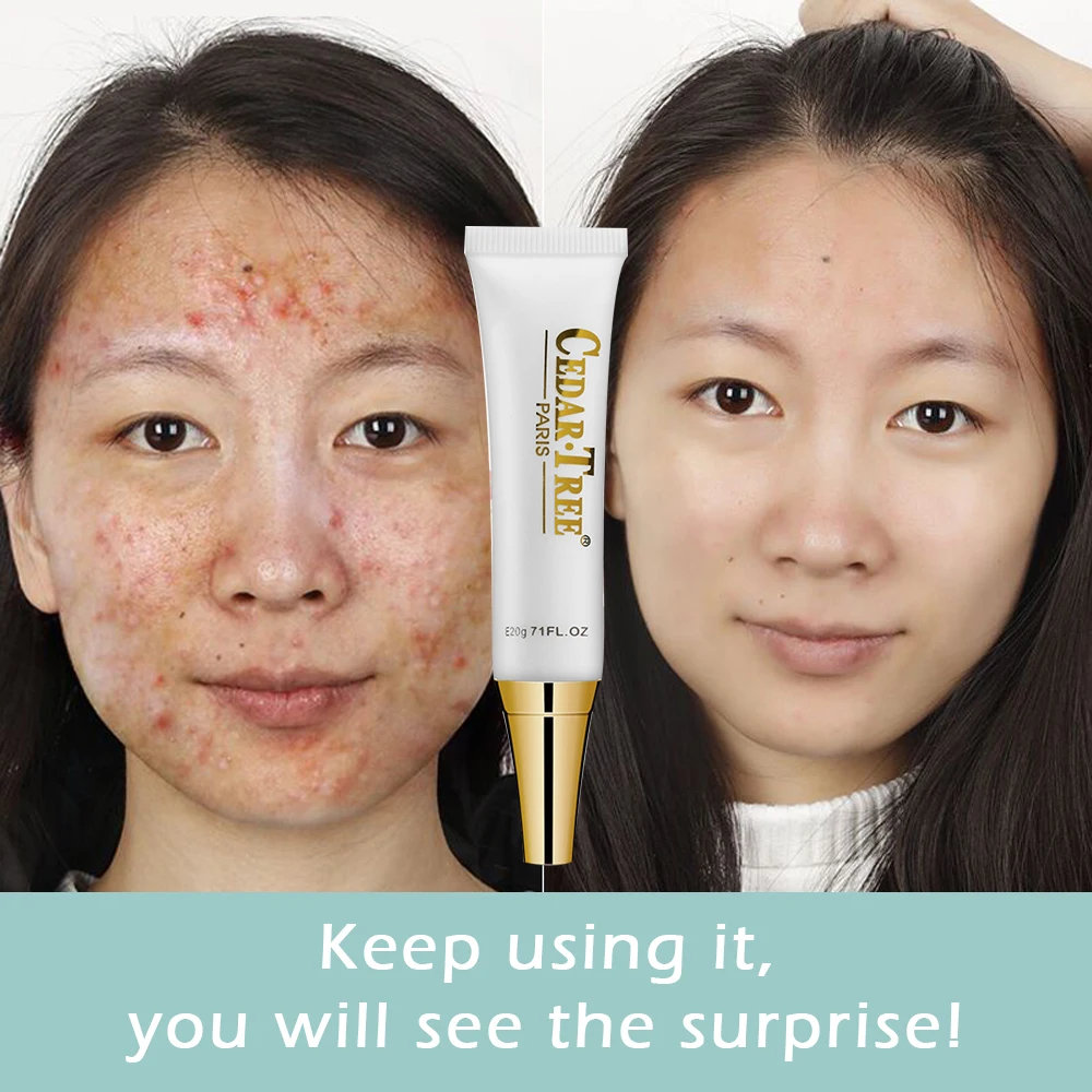 Buy CEDARTREE Remove Acne Cream Acne Treatment Scar
