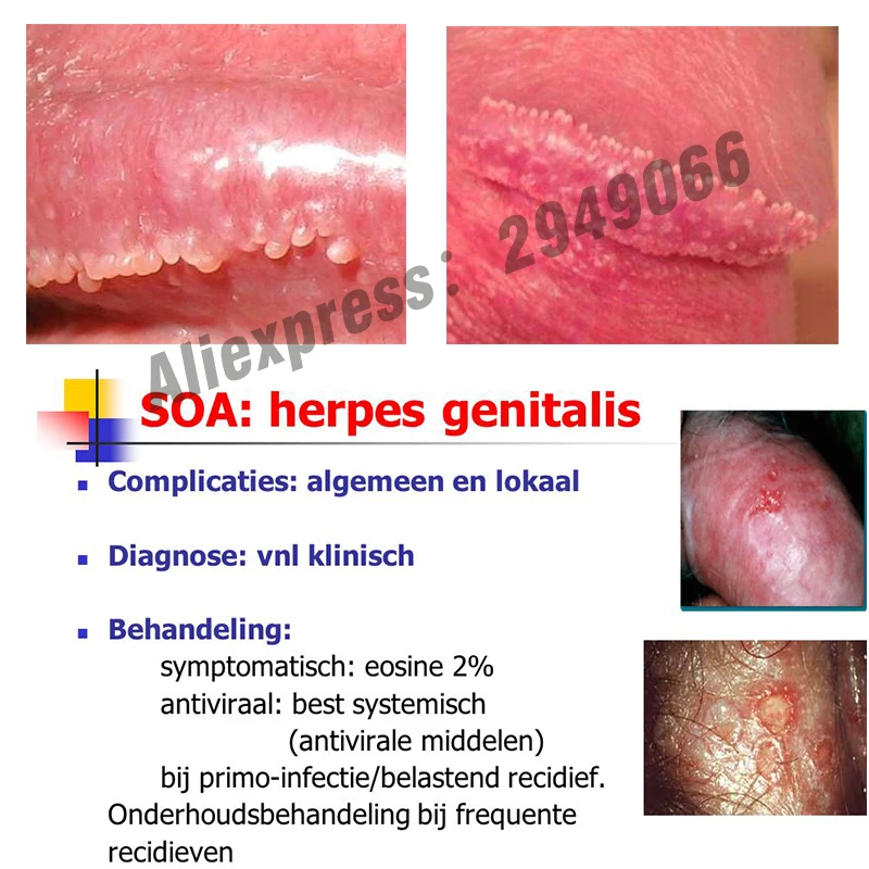 hpv and herpes genital