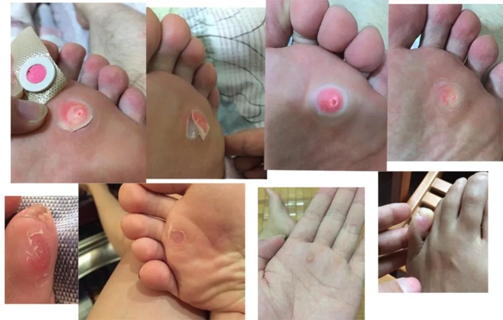 MQ 18 Pieces=3 Boxes Corn Callus Remover Patch Medical Plaster Health Care Corn Cutter Foot Callus Removal