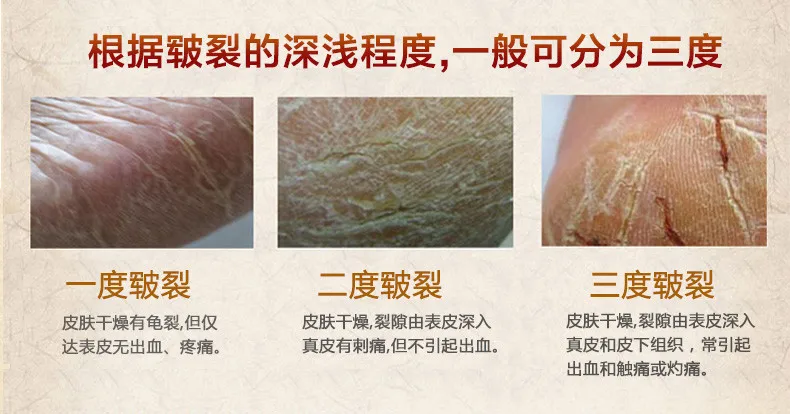 Мощный крем от трещин для рук для ног, против сухого обветренного крема, лечение сухой кожи, пятки, обветренный пилинг, ремонт китайской лекарственной мази