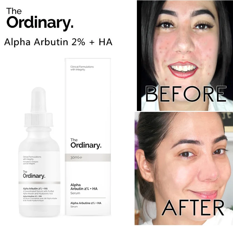 

The Ordinary Alpha Arbutin 2% + HA 30ml Face Whitening Serum Ligthen Dark Spots Acne Marks Freckle Hyper Pigmentation