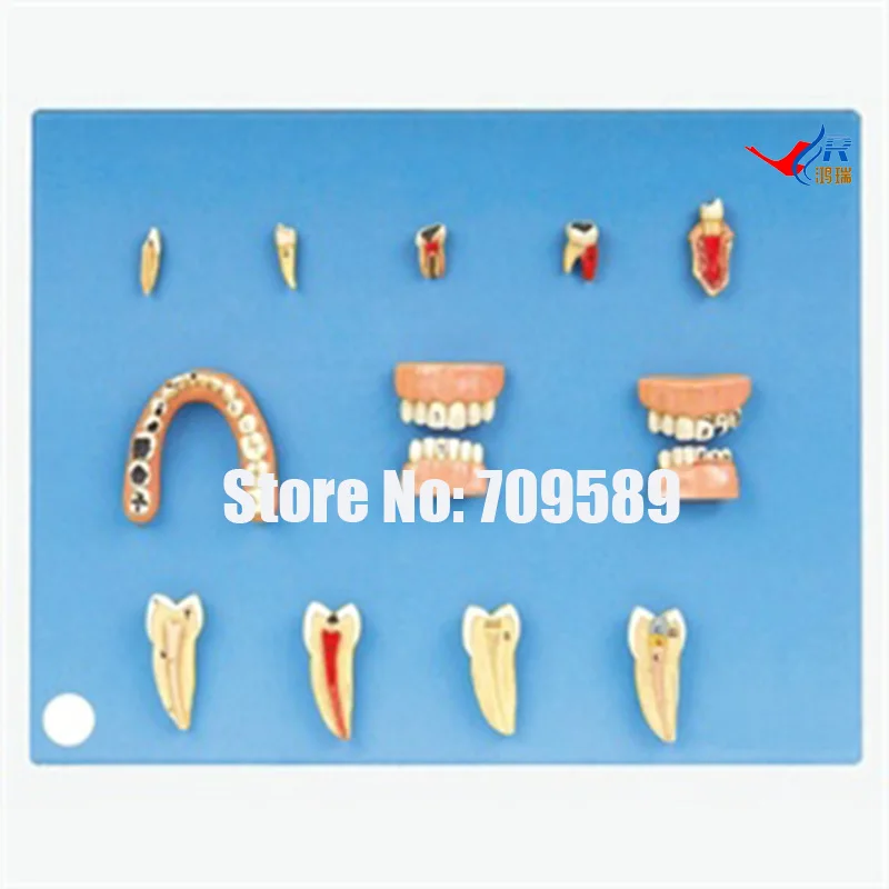 

Dental Diseases Model, Teeth Model