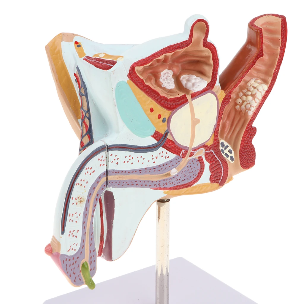 1:1 Human Male Reproduction Urinary System Pathlology Model Gonorrhea Ureteral Calculus Display Medical Study Lab Supplies