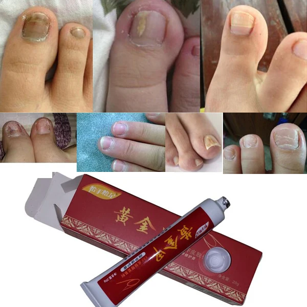 Chinese Medicine Herbs Toe Nail Fungus Treatment Anti Fungal Nail Infection Essence Nail Treatment Removal Nail Care Lotion