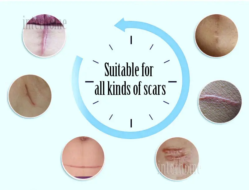 Self-adhesive-silicone-scar-paste(7)