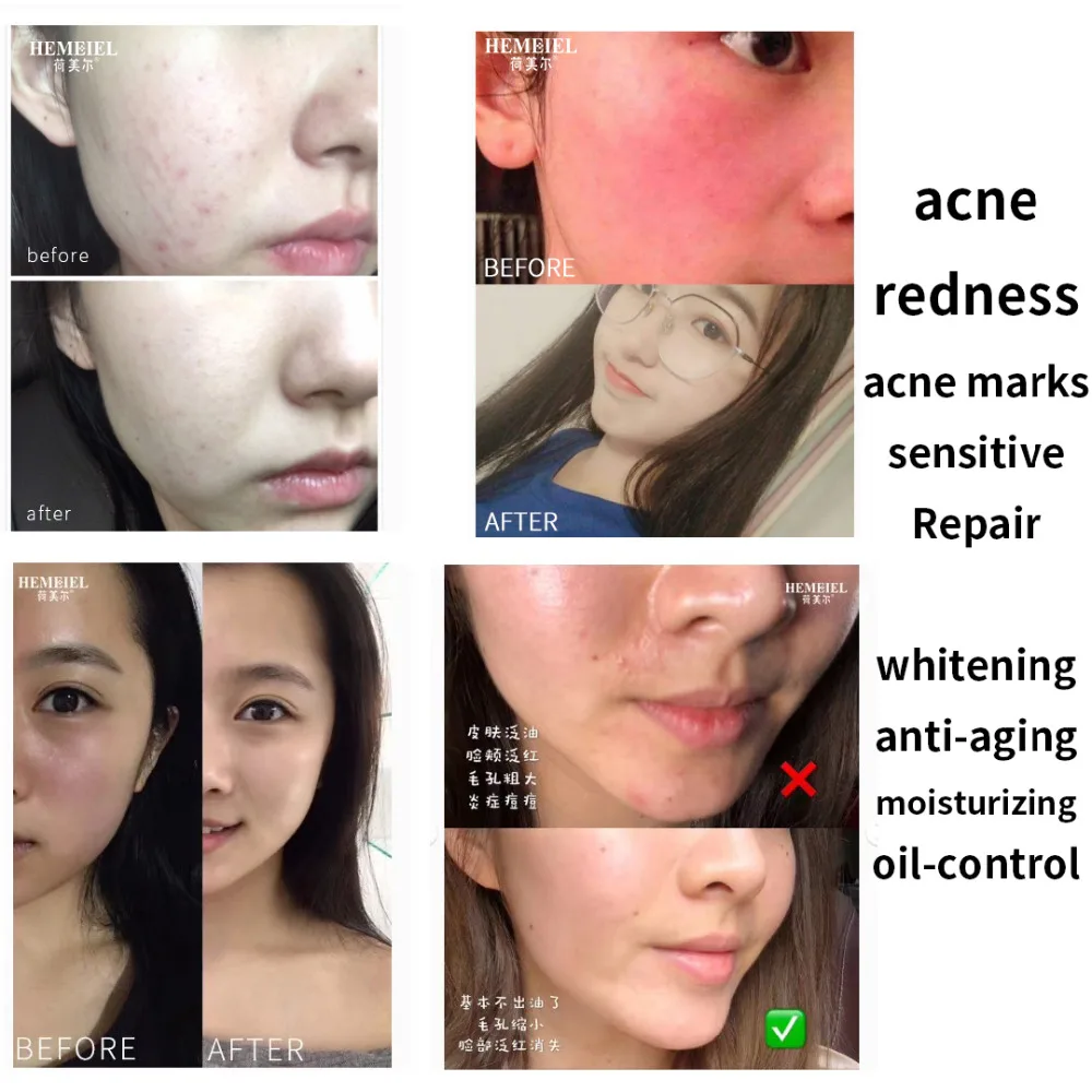 HEMEIEL Sensitive Repair Mask Anti Acne Oil Control Moisturizing Mask Face Whitening Anti Redness Anti Allergy Treatment Mask