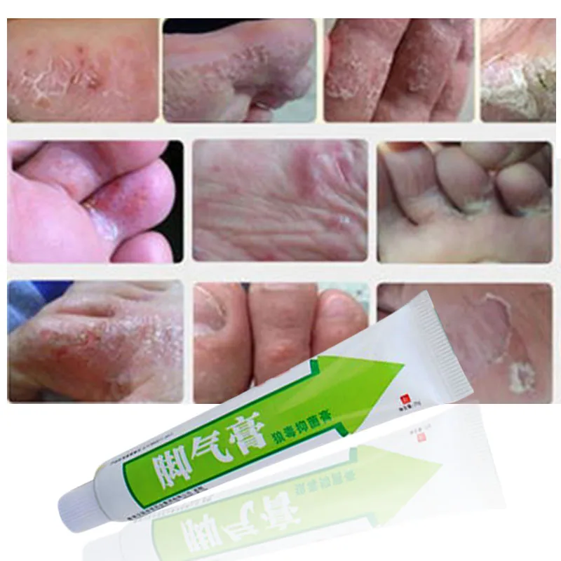 

Foot Cream Feet Care For Athlete's Foot Blisters Peeling Feet Itchy Erosive Beriberi Bad Feet Good Ointment