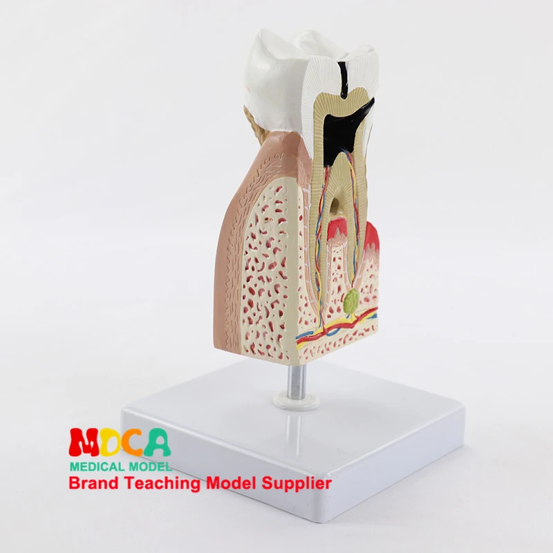 Модель стоматологической анатомии, увеличение зуба, кариес, Дисплей десен, модель медицинского обучения MYC010