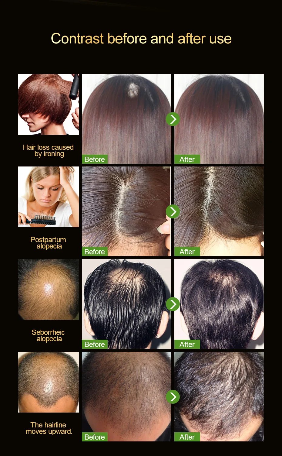 1 шт Анти-выпадение масла продукты Органическая эссенция для быстрого роста волос Жидкое лечение выпадения волос быстрый рост волос TSLM2