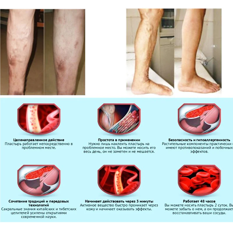 Мазь для варикозных вен Eins лечение Варикозного расширения пластырь для лечения варикозного расширения вен пластырь для лечения васкулита натуральный раствор травяные пластыри