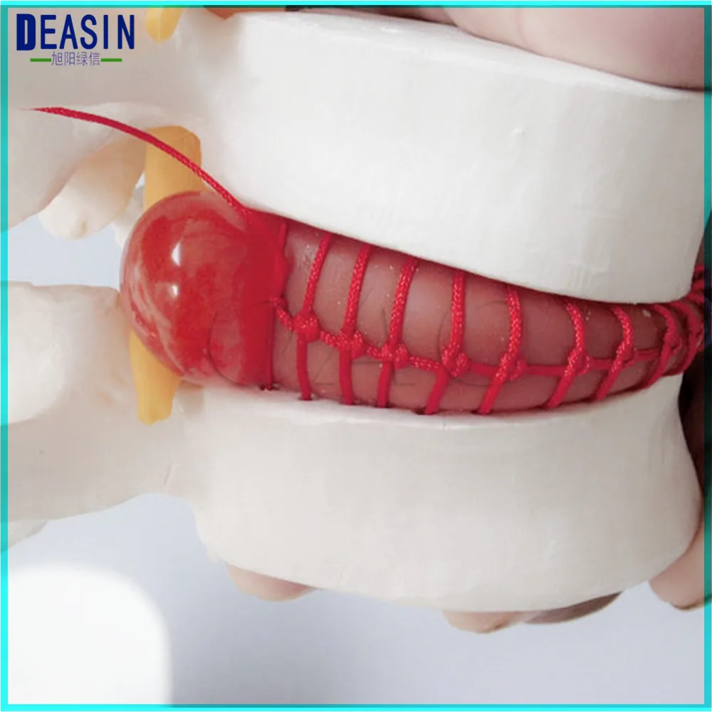 

Human lumbar disc herniation model demonstration model of lumbar vertebral spine model