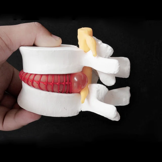 Human Lumbar Disc Herniation Model Demonstration Model of Lumbar