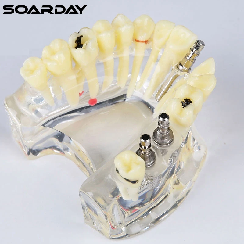 Implant-model-with-bridge-and-caries-4