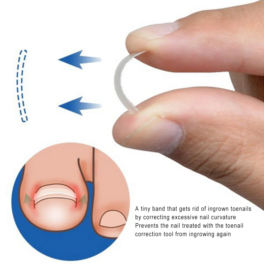 3pcs Ingrown Toenail Pedicure Correction Tools Straightening Clip 3pcs Ingrown Toenail Pedicure Correction Tools Straightening Clip Nail Patch File Glue Treatment Care In Foot Tool From Beauty