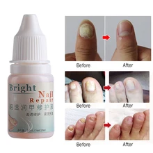 10 мл Лечение ногтей от грибка жидкость яркий ремонт ногтей Onychomycosis эссенция для удаления ухода за ногами яркий инструмент для ремонта ногтей