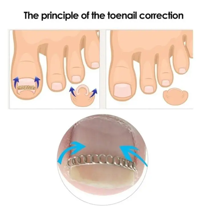 6/12 шт вросшие ногти носок проволочный фиксатор для коррекции ногтей Уход за ногами педикюр инструменты паронихии восстановить Onyxis корректор для большого пальца стопы ног корректор