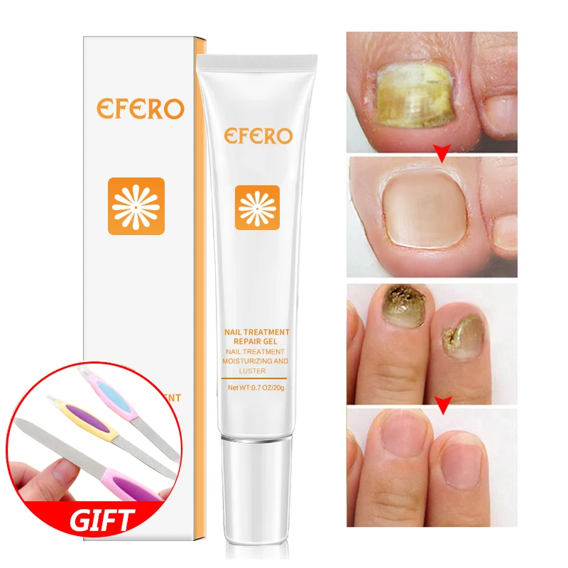 EFERO Антибактериальный Уход за ногтями эфирное масло грибок для ногтей Инструменты для ремонта крема Уход за ногтями на ногах улучшение инфекции